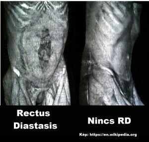 Rectus Diastasis